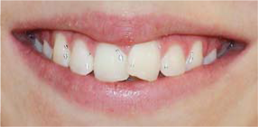 Vor der Invisalign®-Behandlung